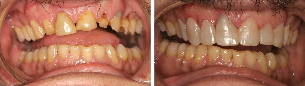 Before and After Composite Bonding Photo