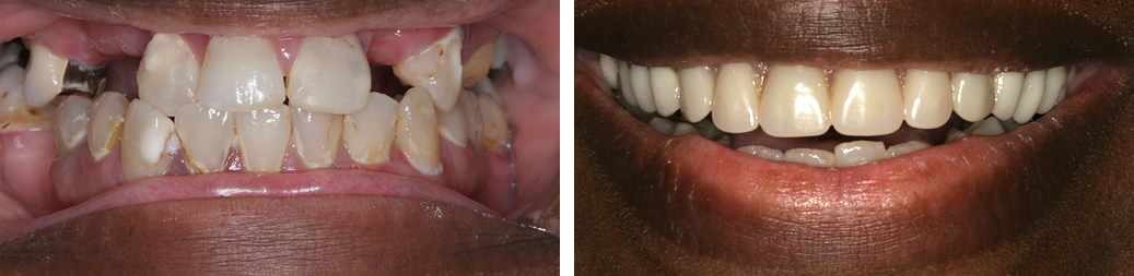 Before and After Dentures Photo