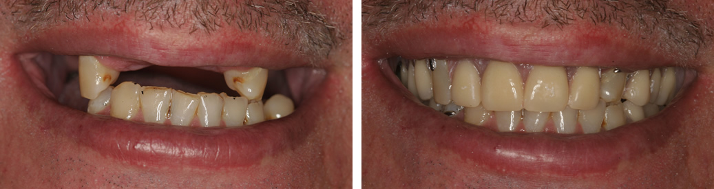 Before and After Partial Dentures Photo