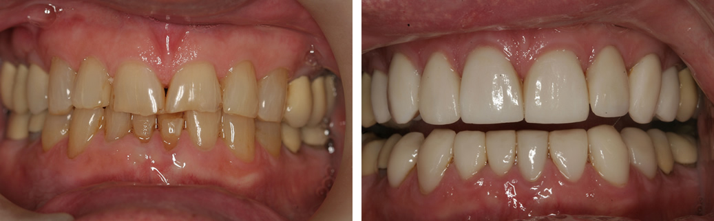 Before and After Veneers Photo