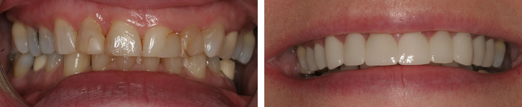 Before and After Porcelain Crowns Photo